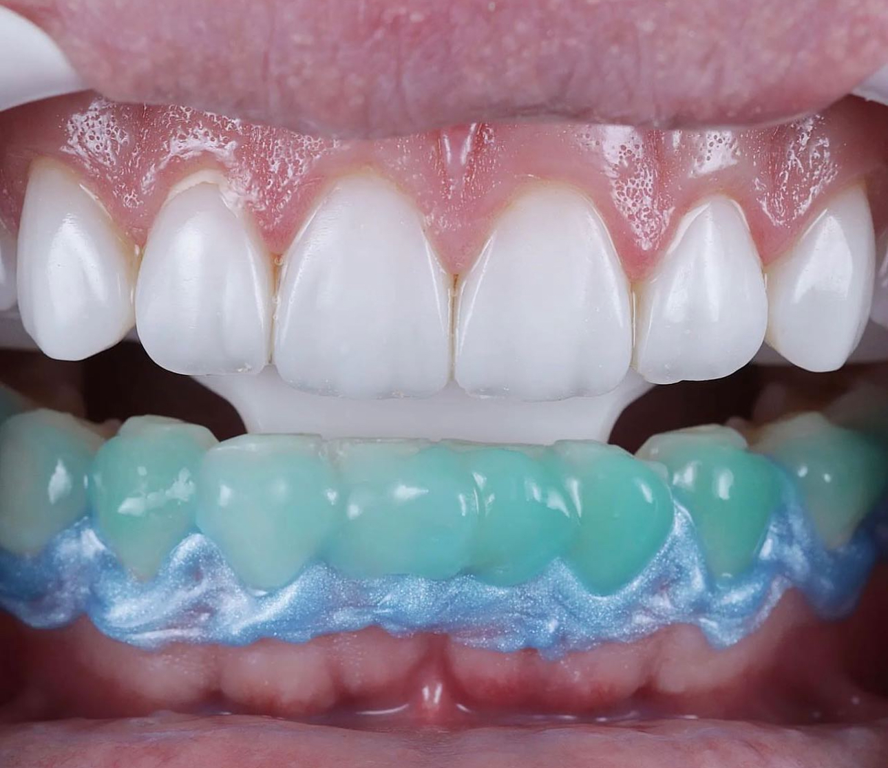 Blanqueamiento Dental